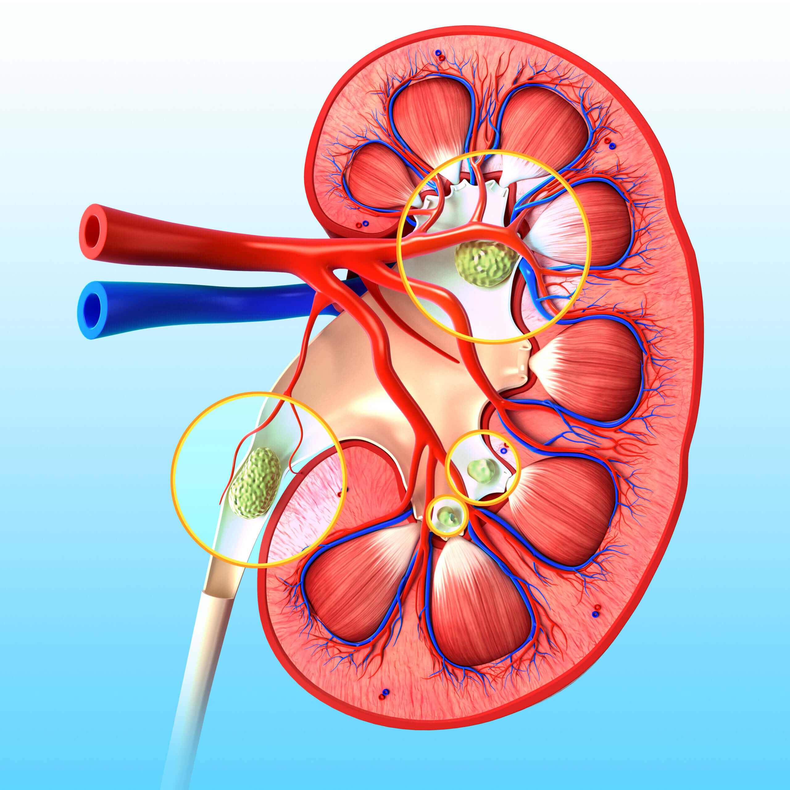 Anatomy of kidney stone Abbildung eines menschlichen Innenniere mit Nierensteinen in verschiedenen Bereichen.