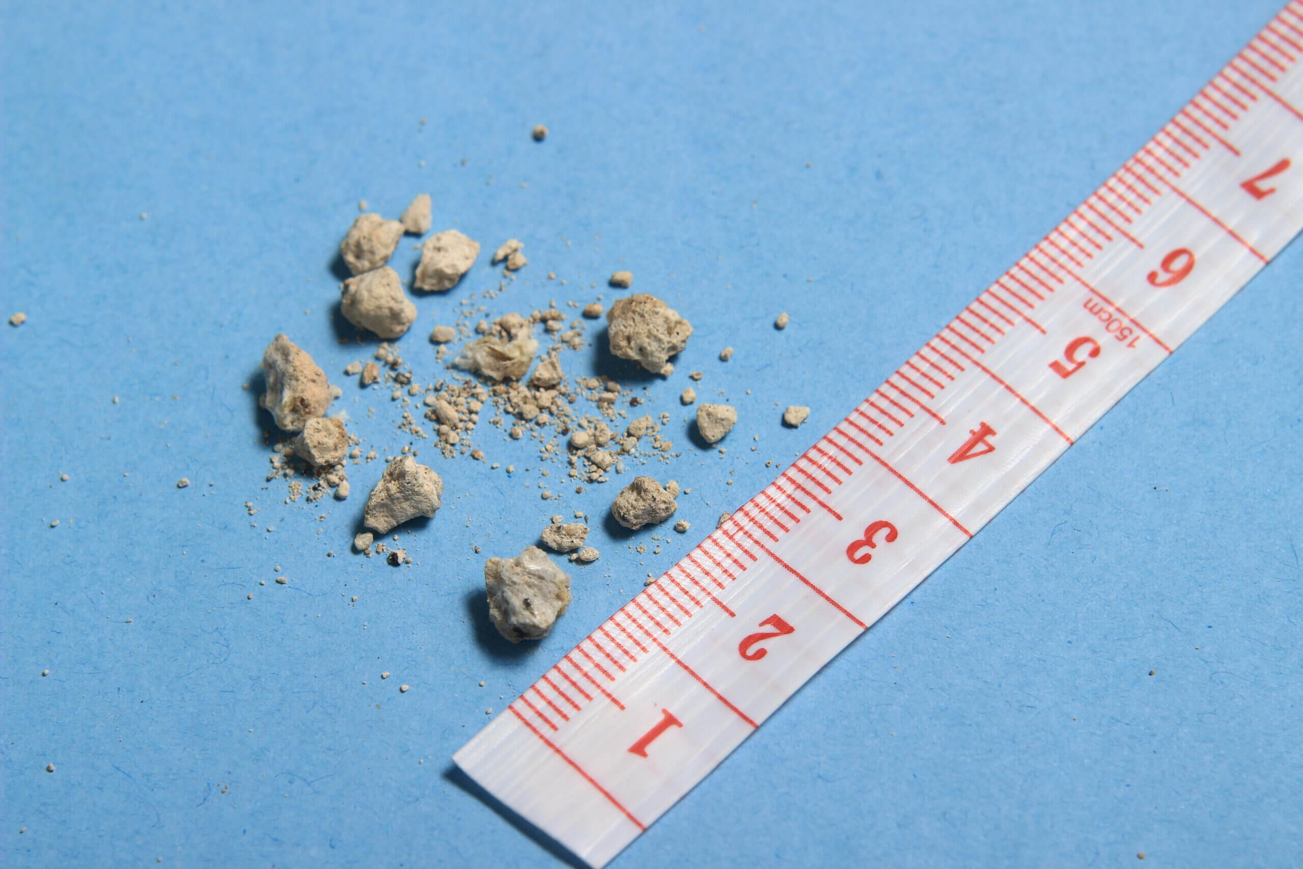 flat lay or top view very small kidney stones with ruler at blue background Steine auf blauer Fläche neben einem Maßband.